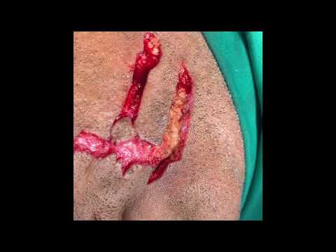 Primary Meticulous Suturing- Important In Facial Plastic Surgery