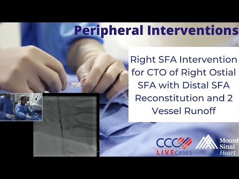 R SFA Intervention CTO of R Ostial SFA w/ Distal SFA Reconstitution & 2 Vessel Runoff - Periph 3/17