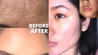 How to get rid of Tiny bumps | FUNGAL ACNE SAFE PRODUCTS to get CLEAR, SMOOTH & GLASS SKIN TEXTURE