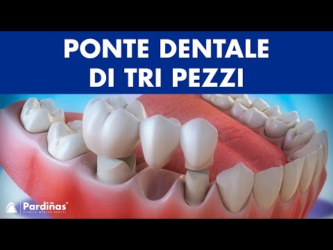 Ponte dentale di tri pezzi ©