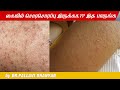 Keratosis Pilaris Skin Facts Dermatologist Dr Pallavi Dhanyan
