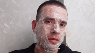 Mi experiencia con el Láser CO2 DEKA,donde me lo hice,cuanto cuesta,que tiempo dura y otras pregunta