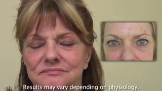 Fraxel R:epair laser for Sun Spots, age spots, wrinkle treatment, south bay, Los angeles California