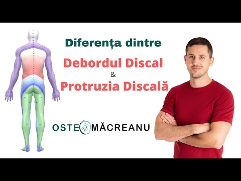 Displazia de dezvoltare a tratamentului articulațiilor șoldului