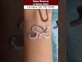 Tattoo Removal At Skinaa Clinic Shorts