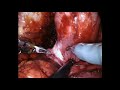 RARP, Median Lob Diseksiyonu / A. Erdem Canda
