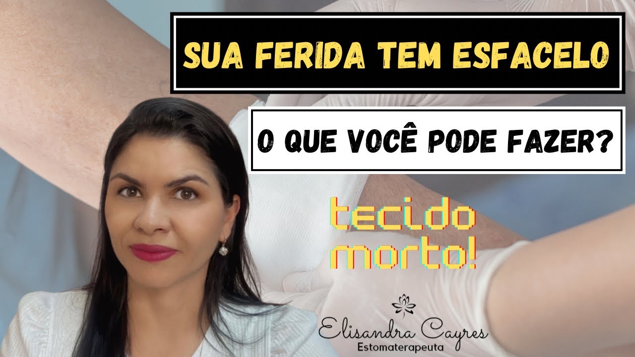 SUA FERIDA TEM ESFACELO O QUE VOCÊ PODE FAZER?