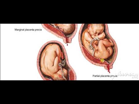 Placenta previa