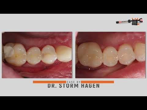 CLEARFIL MAJESTY ES-2 UNIVERSAL, шприц 3,6 г (Kuraray Noritake) - фото 4 - id-p2801454596