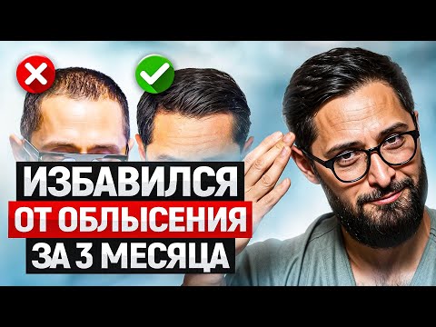 Мужское облысение - не приговор! Моя история избавления от залысин без пересадок