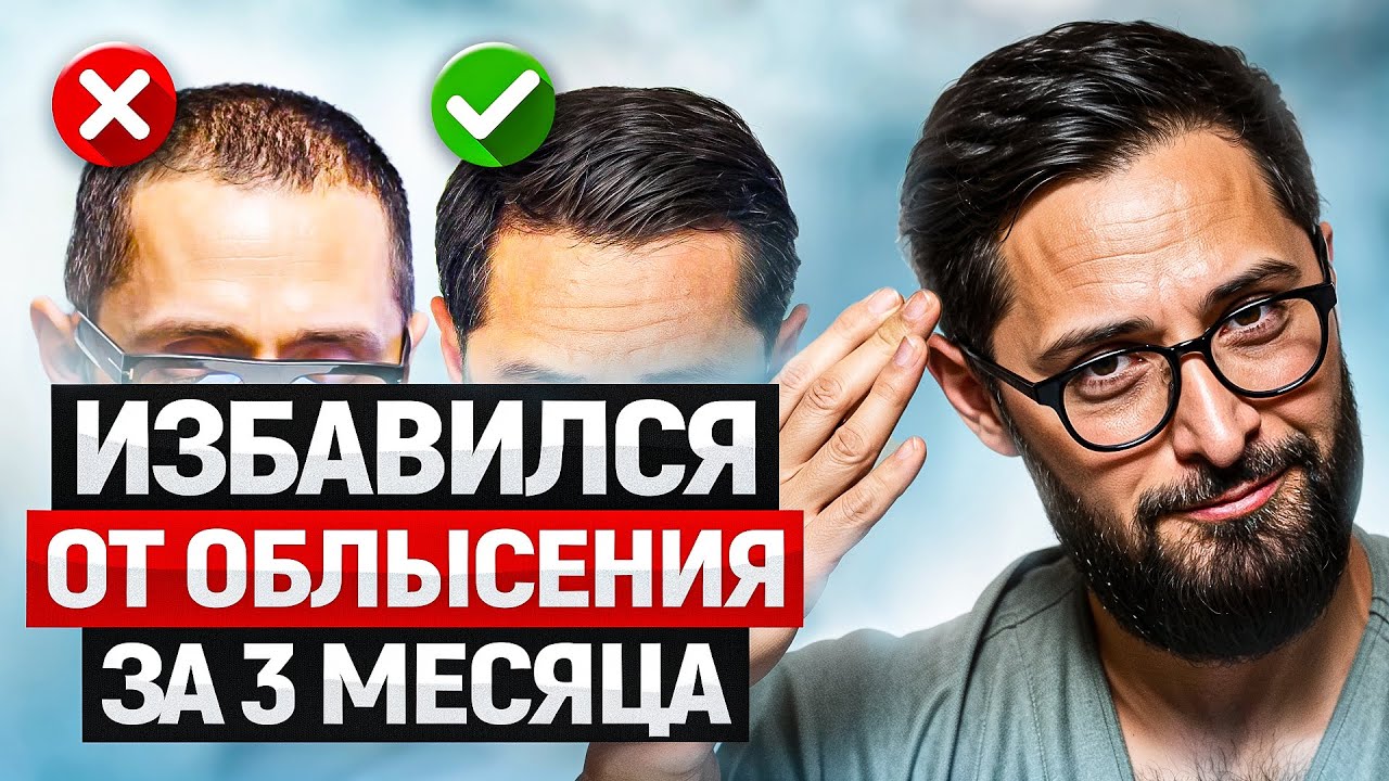 Мужское облысение - не приговор! Моя история избавления от залысин без пересадок