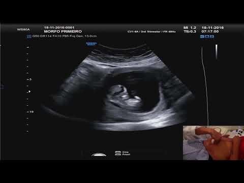 Tutorial Morfológico 1º Trimestre - Marcadores de Cromossomopatias ( TN /ON / DV / RT)
