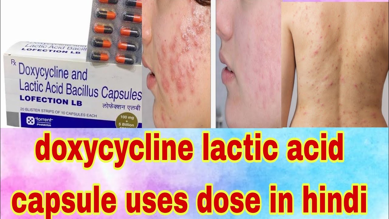 Watch video doxycycline and lactic acid bacillus capsule uses | doxycycline tablets uses in hindi Now doxycycline and lactic acid bacillus capsule uses | doxycycline tablets uses in hindi