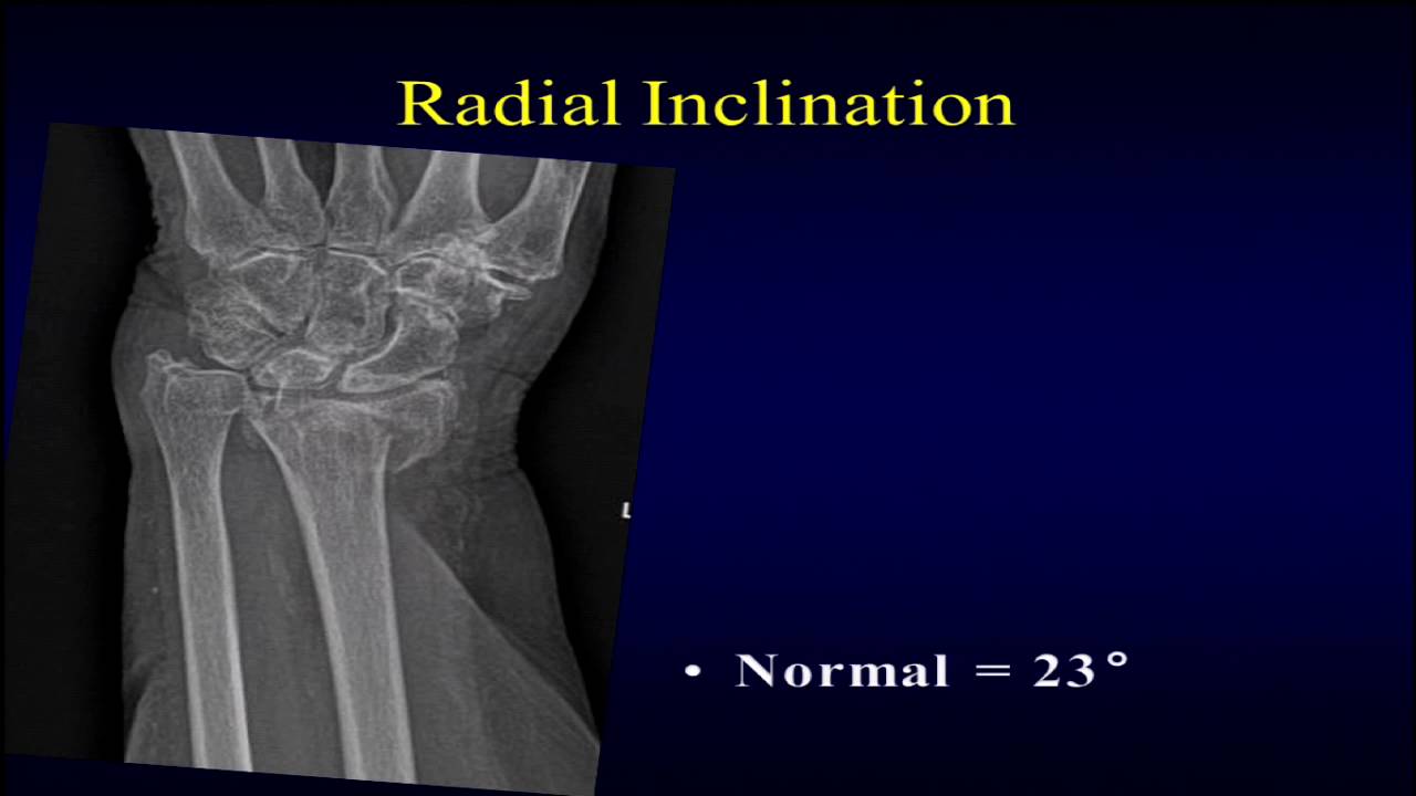 Distal radius fractures: what to look for on radiographs