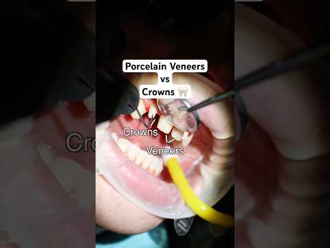 Porcelain Veneers vs. Crowns: What's the difference🤔#porcelainveneers #dentalcrowns #smilemakeover