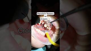 Porcelain Veneers vs. Crowns: What's the difference🤔#porcelainveneers #dentalcrowns #smilemakeover