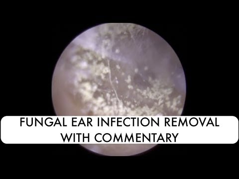 Ekzoderil parmasya sa Izhevsk Isang kasangkapan para sa paggamot ng kuko halamang-singaw pinakamahusay na mga review