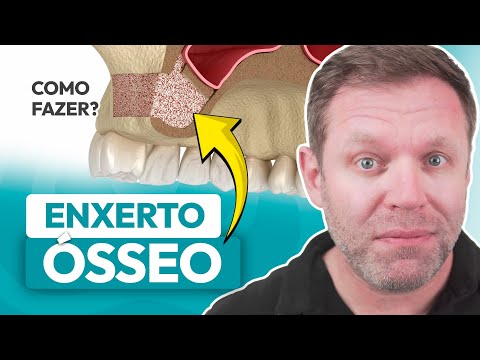 Não Tenho Osso Para Colocar Implantes Dentários - Qual é a Solução?