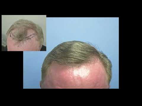 Failed double FUE salvage by Dr. Lindsey using FUT, hair restoration and interview in DC | McLean thumbnail