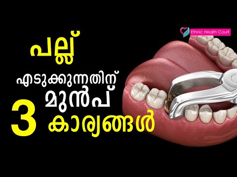 പല്ല് എടുക്കുന്നതിനു മുൻപ്  ശ്രദ്ധിക്കേണ്ട കാര്യങ്ങൾ | pallu edukkal | Ethnic Health Court
