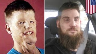 Full face transplant: Mitch Hunter lost face in crash that zapped him with 10,000 volts - TomoNews