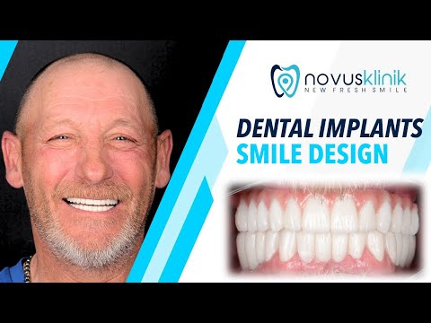 Full Mouth Dental Implants and Zirconia Crowns in Turkey Before and After Results