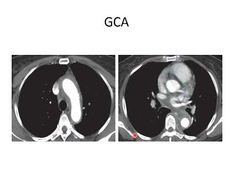 Imaging spectrum of aortitis