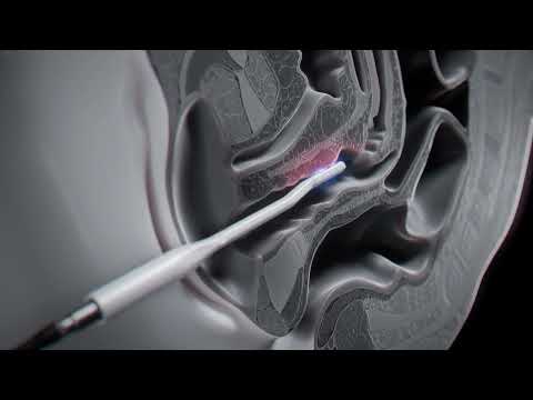 DEKA Laser - RF Touch - Noua Radiofrecvență Bipolară pentru Sănătatea Intimă a Femeilor