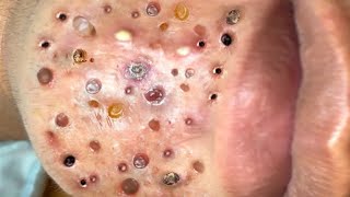 Loan Nguyen Acne Treatment 22n