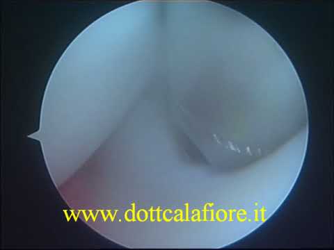 Mal di schiena ricorrente è una lotta Perché danneggiare le articolazioni del ginocchio e come trattarla