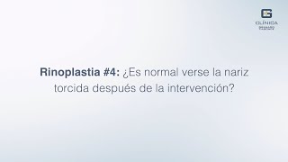 RINOPLASTIA #4: ¿Es normal verse la nariz torcida tras la intervención || Clínica Granado Tiagonce