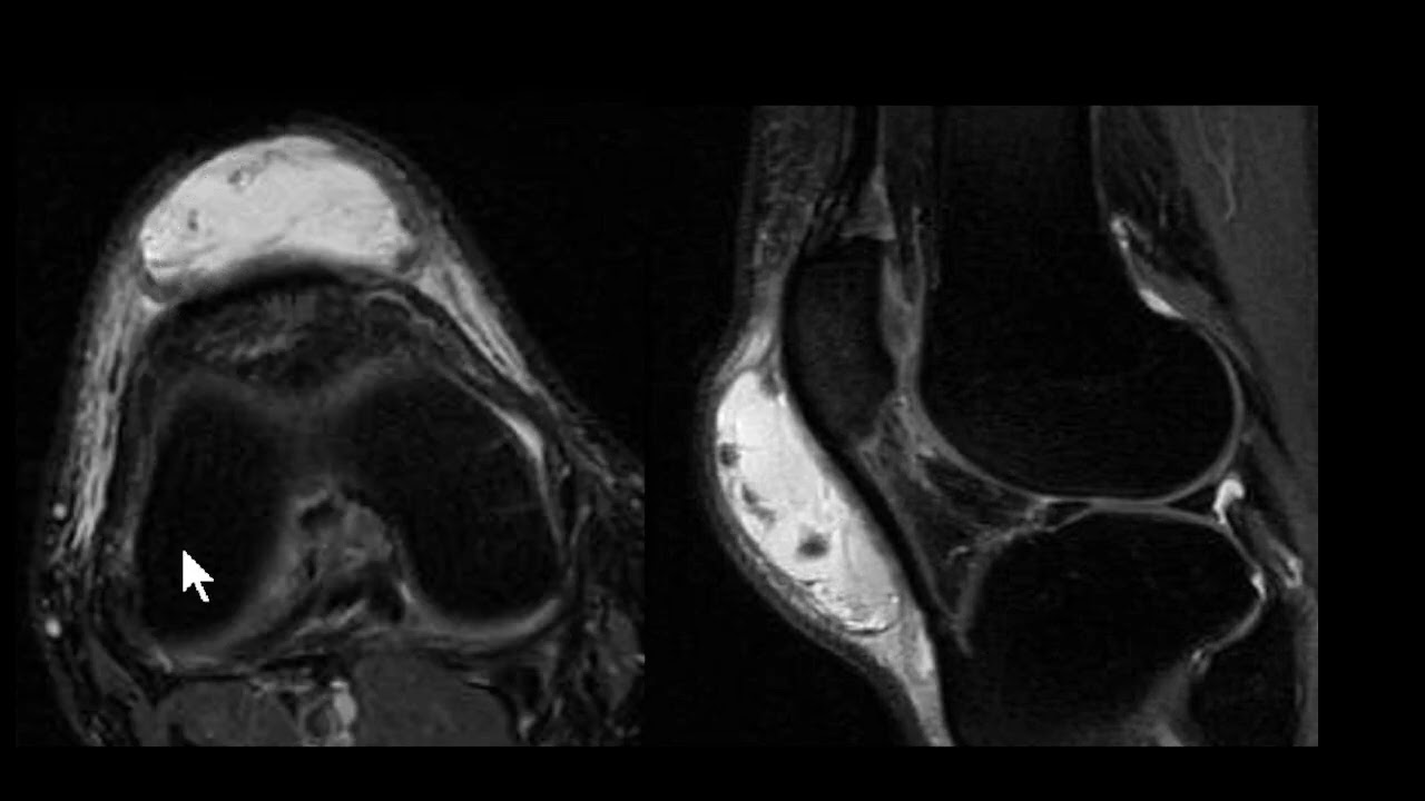 Bursite pré patelar