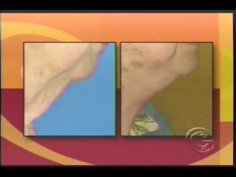 Goodbye Turkey Neck:  Dr. Leedy discusses Neck Rejuvenation