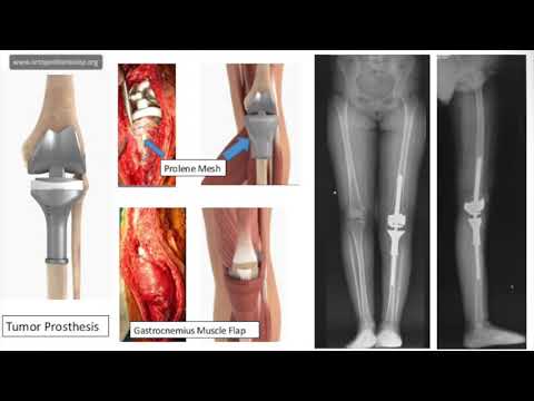 Artroza traumatică a genunchiului