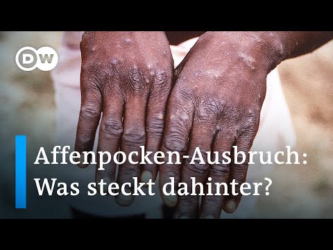 Affenpocken-Ausbruch in Europa: Wie schnell verbreiten sich Infektionen? | DW Nachrichten