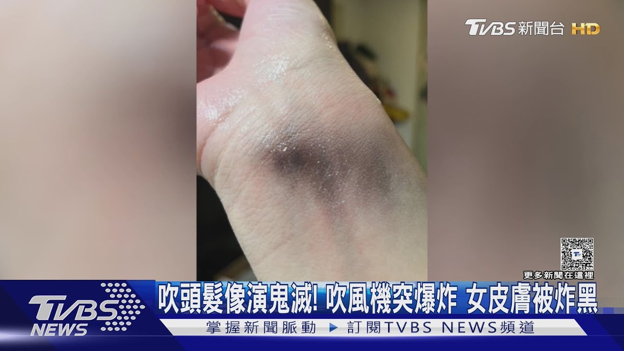吹頭髮像演鬼滅! 吹風機突爆炸 女皮膚被炸黑
