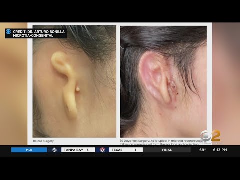 Woman receives 3D-printed ear made of human cells