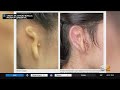 Woman Receives 3D Printed Ear Made Of Human Cells