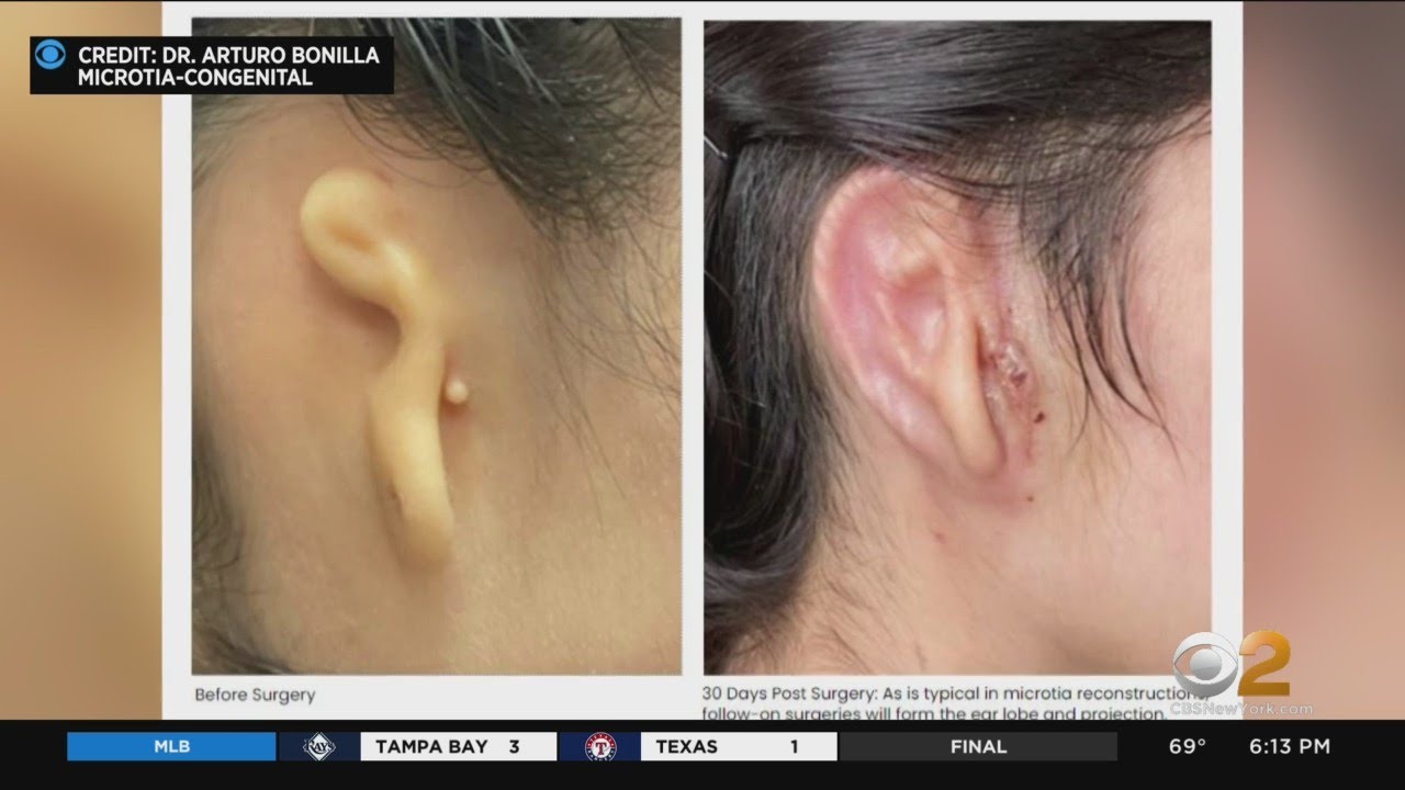 CBS New York news segment covering the first 3D-bioprinted ear transplant performed by Dr. Arturo Bonilla