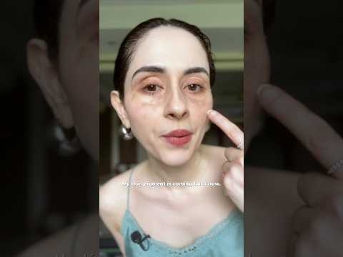 Can you believe this? #vitiligo