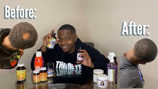 HOW I GREW MY BALD SPOT BACK FAST -NATURAL HAIR GROWTH TREATMENT