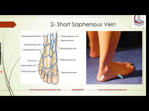 Varicose Doppler Anatomy & Pathophysiology by Dr.Kareem A.Abdelaziz..part (2/2)