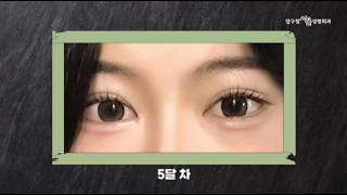 �� ���� ���� ���������� ��� Before & After