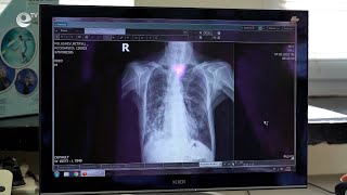 20 са случаите на туберкулоза в Кърджали от началото на тази година