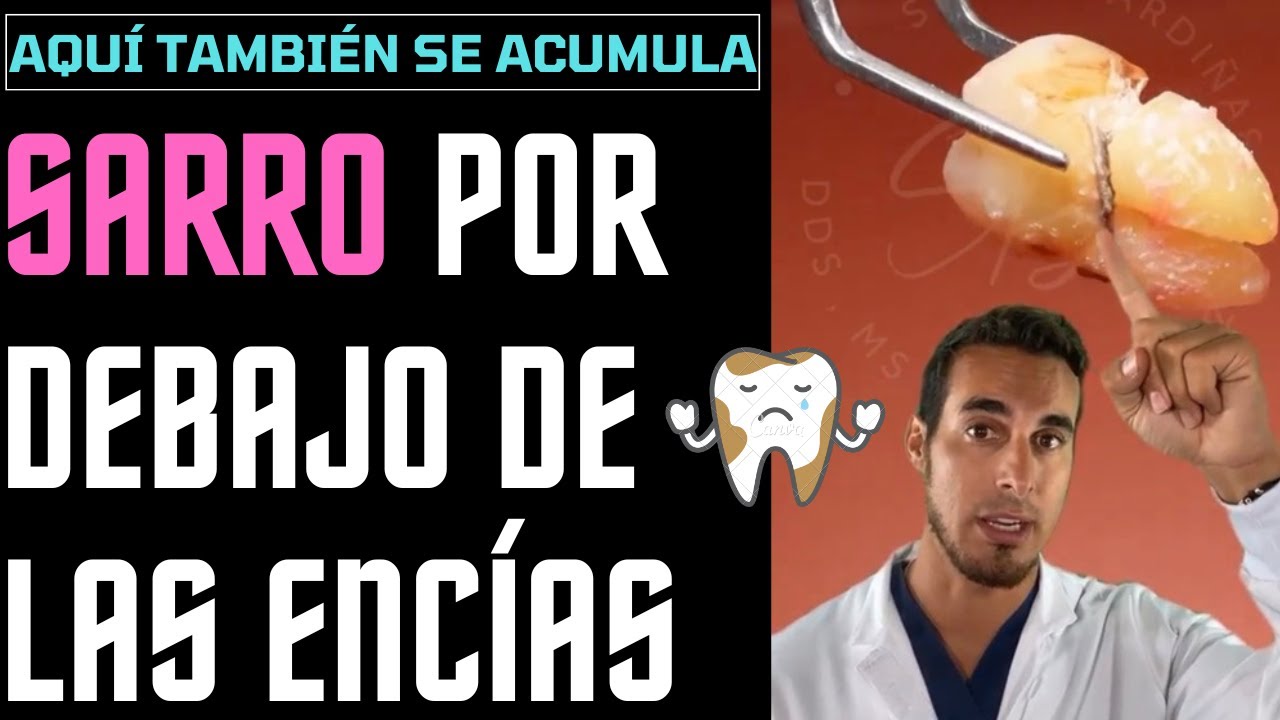 Watch El SARRO DENTAL también se acumula por debajo de las ENCÍAS - Esto te puede pasar Now El SARRO DENTAL también se acumula por debajo de las ENCÍAS - Esto te puede pasar