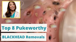 Dr Pimple Poppers 8 WORST Blackhead Removals - You