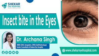 Treating Insect Bites in the Eyes | First Aid for insect bite | Shekar Eye Hospital
