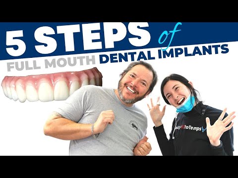 Full Mouth Dental Implant Procedure Step-by-Step