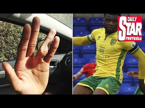 Efete's gruesome dislocated finger suffered during torquay training