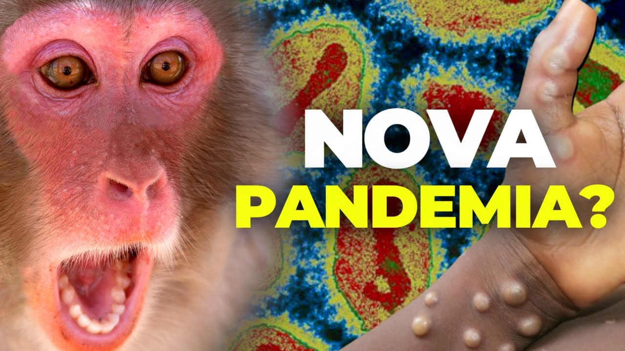 O PERIGO DA MPOX QUE AINDA NÃO TE CONTARAM